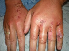 bike wreck injuries bike-wreck-001